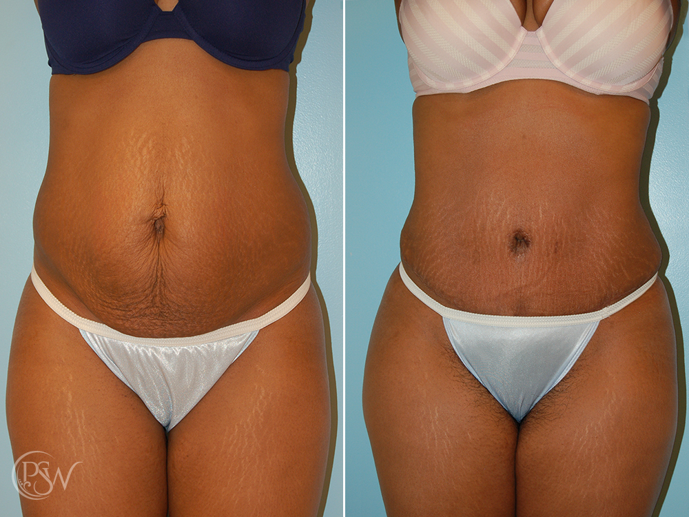 Tummy Tuck (Abdominoplasty) - New York Liposuction Center