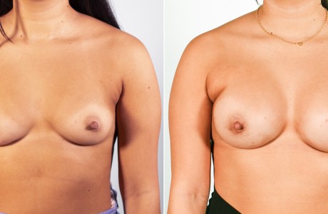 breast-aug2-1-6-4-24