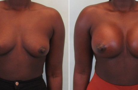 breast-aug4-1-6-4-24