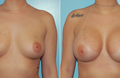 breast-aug5-1-6-4-24